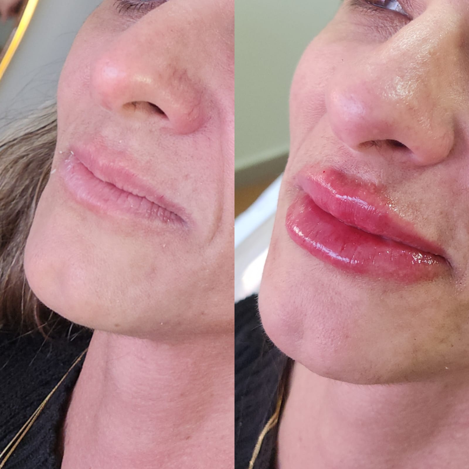 Preenchimento Labial - Antes e Depois
