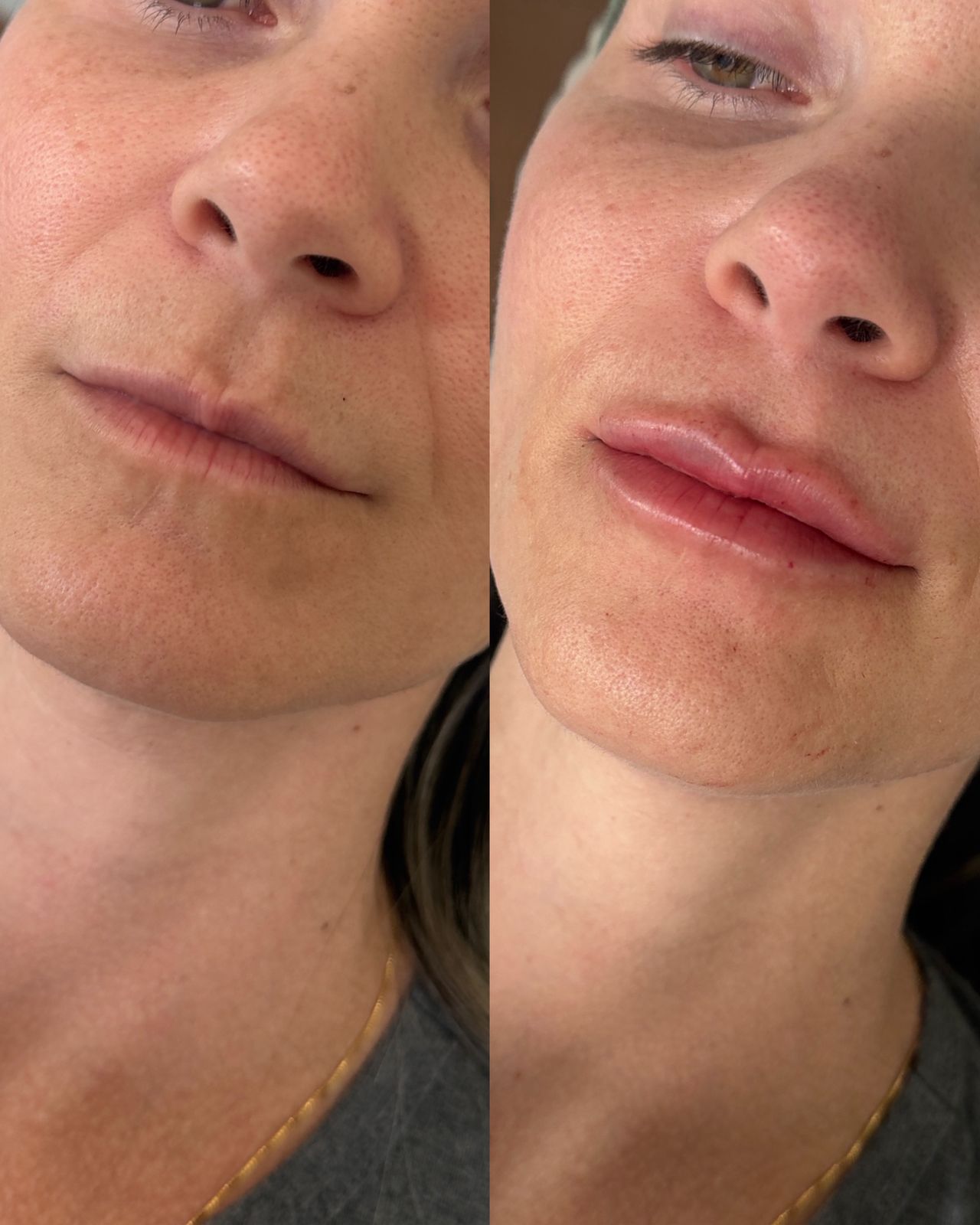 Preenchimento Labial - Antes e Depois